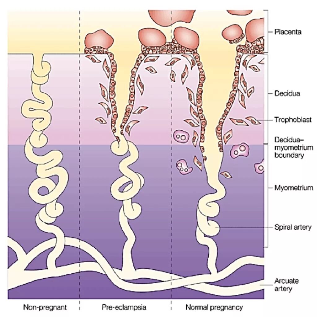 Преэклампсия спиральные артерии. Инвазия трофобласта в спиральные артерии. Механизм развития преэклампсии. Патогенез преэклампсии схема.