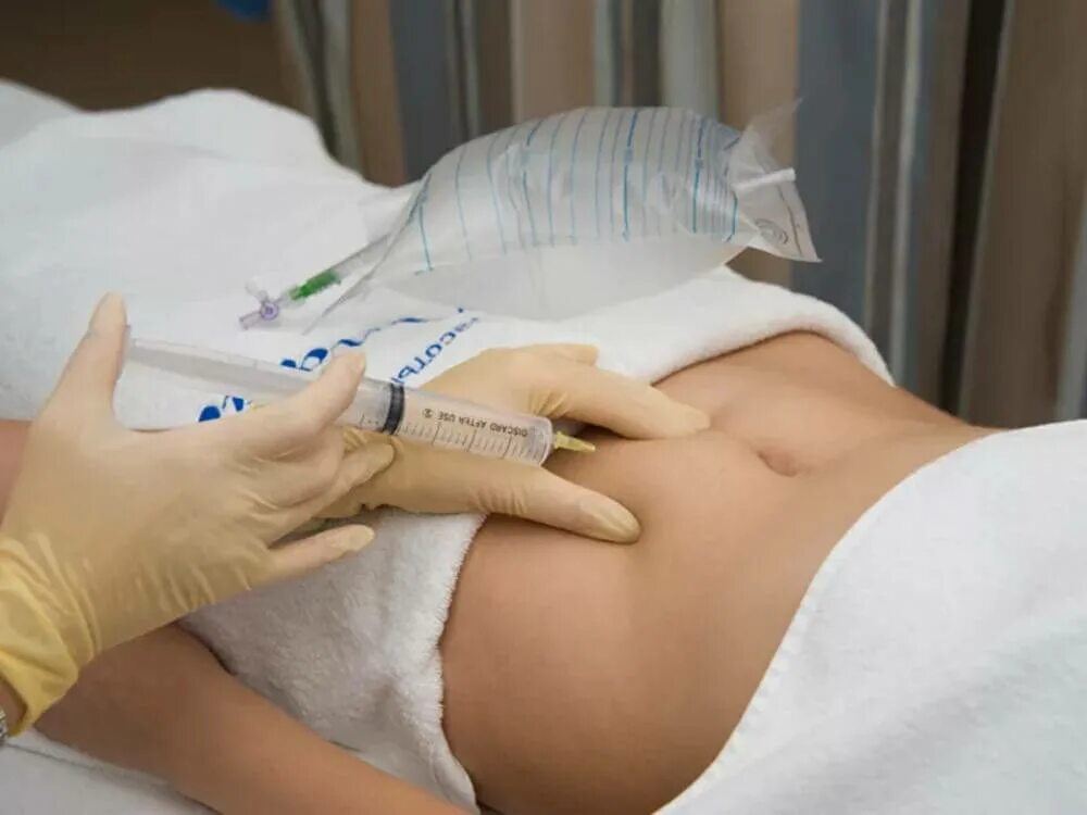 Озонотерапия при беременности. Введение гепарина в живот. Укол подкожно в живот. Озонотерапия.