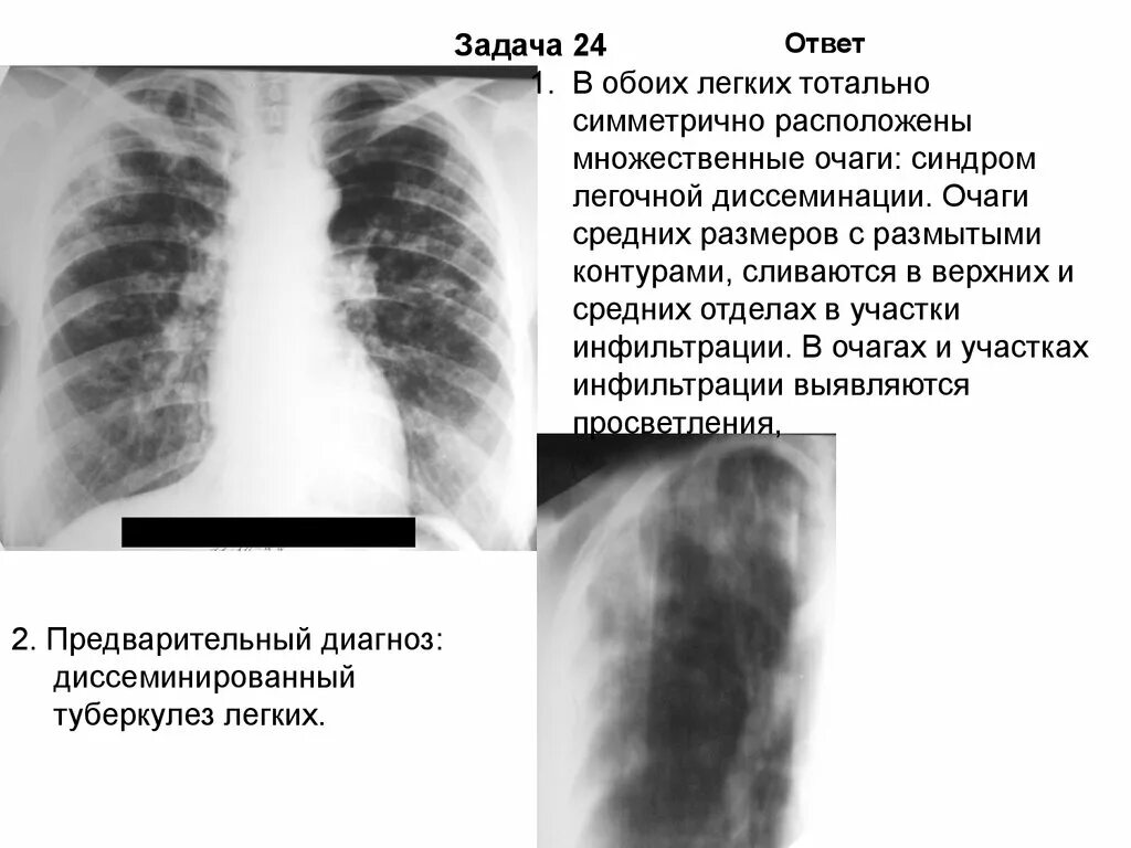 Образования обоих легких