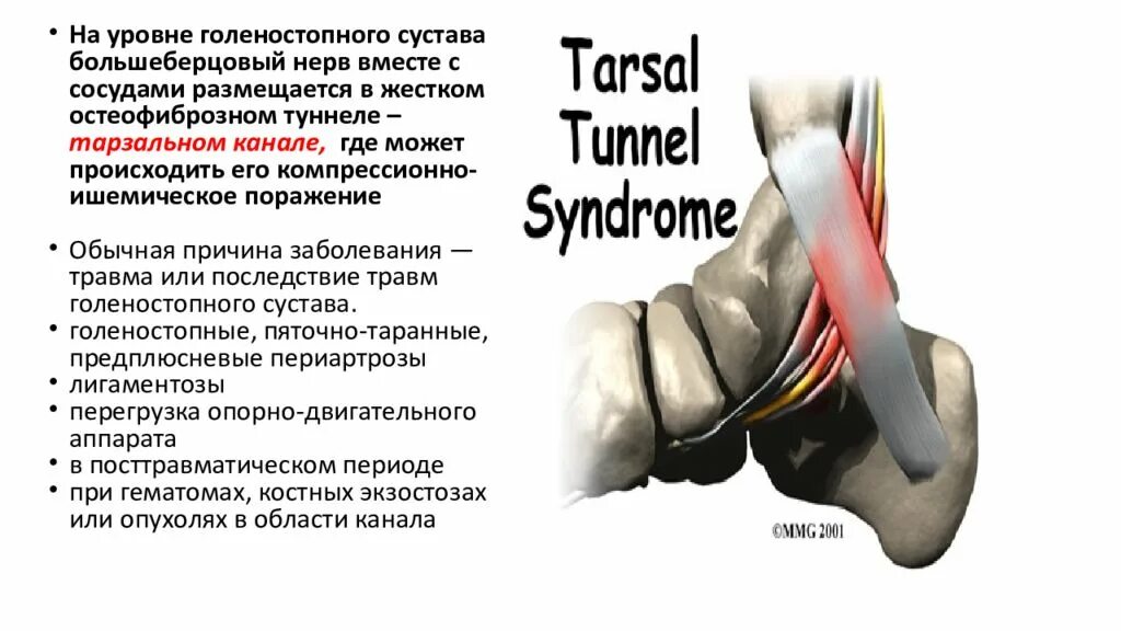 Поражение нервов нижних конечностей. Туннельные невропатии нижних конечностей. Тарзальный туннельный синдром. Большеберцовый туннельный синдром. Тарзальный канал большеберцового нерва.