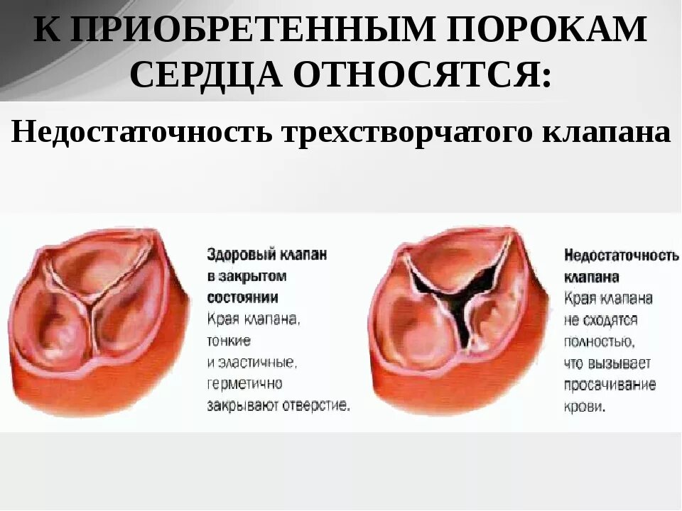 Поражение митрального клапана. ВПС двустворчатый аортальный клапан. Приобретенные пороки аортального клапана. Двухстворчатый клапан сердца порок. Порок трехстворчатого клапана сердца.