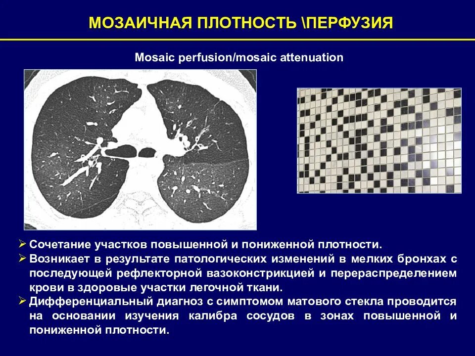 Плотность легкого материала. Мозаичная перфузия легких. Мозаичная структура легочной ткани. Мозаичная структура легких на кт. Мозаичная перфузия кт.