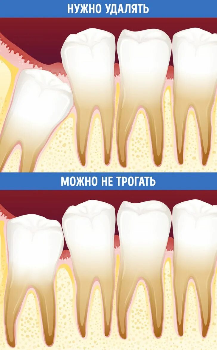 Удалённый зуб мудрости. Удаленные зубы мудрости. Удаление зуба семерки