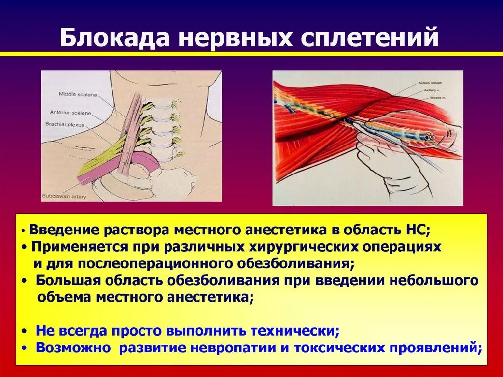 Периферические нервы и сплетения. Регионарная анестезия плечевого сплетения. Блокада плечевого сплетения. Проводниковая блокада плечевого сплетения. Блокада нервных стволов и сплетений.