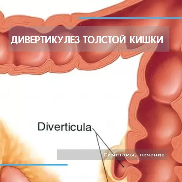 Дивертикулёз сигмовидной кишки. Дивертикулез кишечника. Дивертикулез сигмовидной кишки. Дивертикулез толстой кишки. Дивертикулез сигмовидной кишки диета лечение