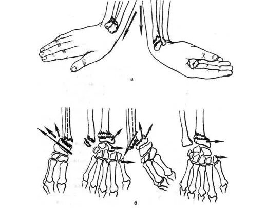 Лечебная гимнастика после перелома лучезапястной кости кисти. ЛФК после перелома руки пястной кости. ЛФК после перелома пястной кости руки со смещением. ЛФК после перелома лучезапястной кости со смещением. Лфк лучезапястного сустава после перелома со смещением