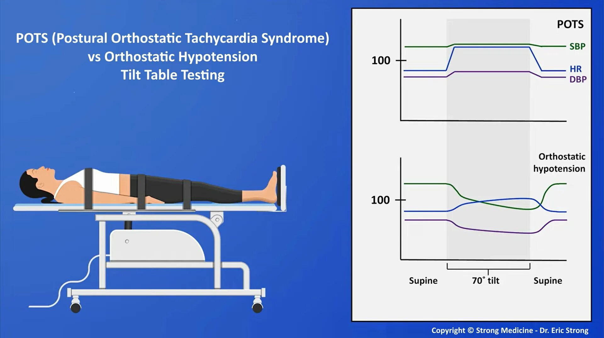 Postural Orthostatic tachycardia Syndrome. Pots синдром. Orthostatic hypotension. Tilt Table Test. Rest test