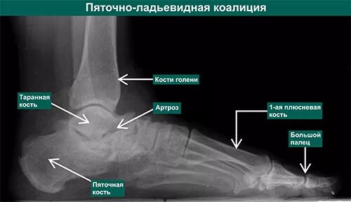 Пяточно коалиция. Таранно-ладьевидная коалиция. Тарзальная коалиция рентген. Пяточно-ладьевидная коалиция мрт. Таранно-пяточная коалиция.