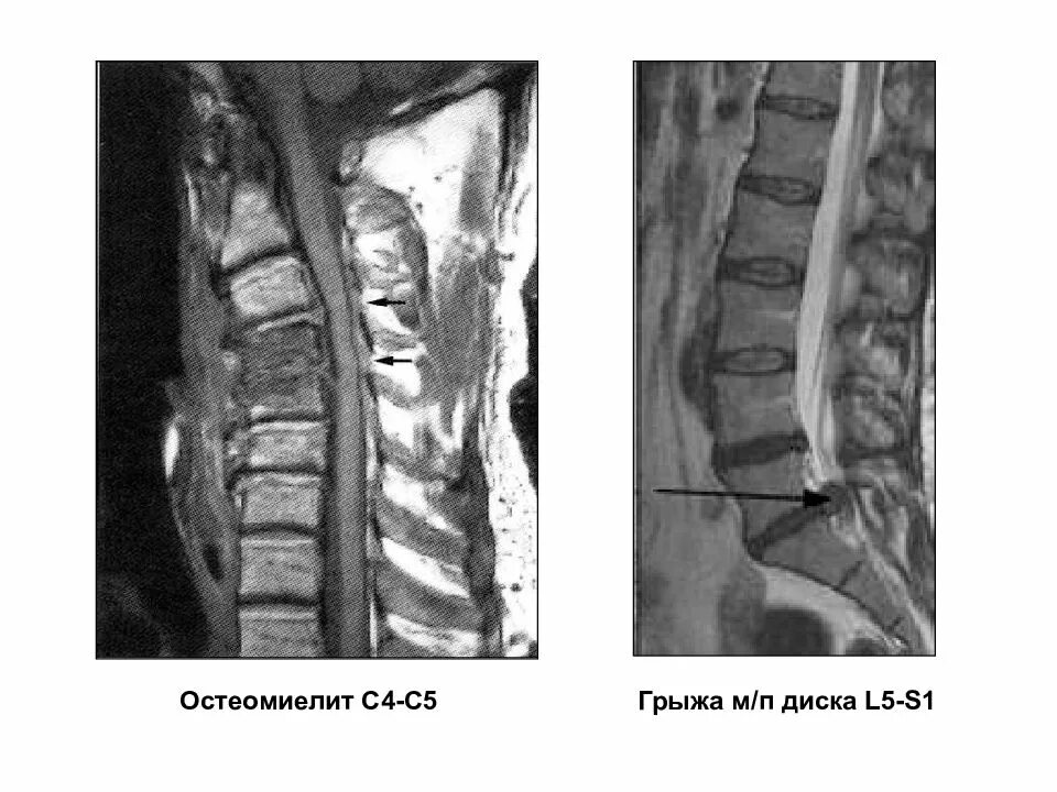 Дисков c5-c6. Грыжа с4-с5 шейного. Протрузии дисков с4-с6. Грыжи дисков с3-с4 шейного отдела.