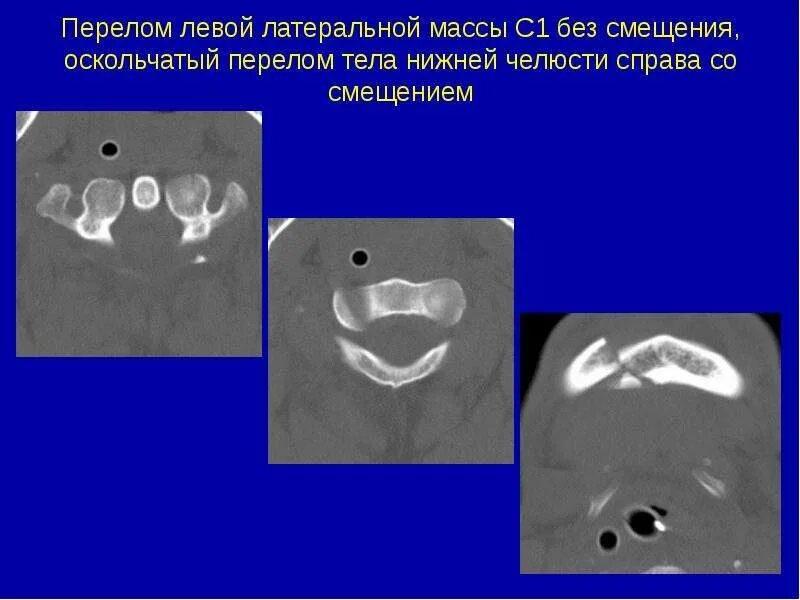 Перелом боковых масс крестца. Перелом боковой массы крестца справа. Перелом s4. Перелом боковых масс крестца кт. Подвывих копчика рентген.