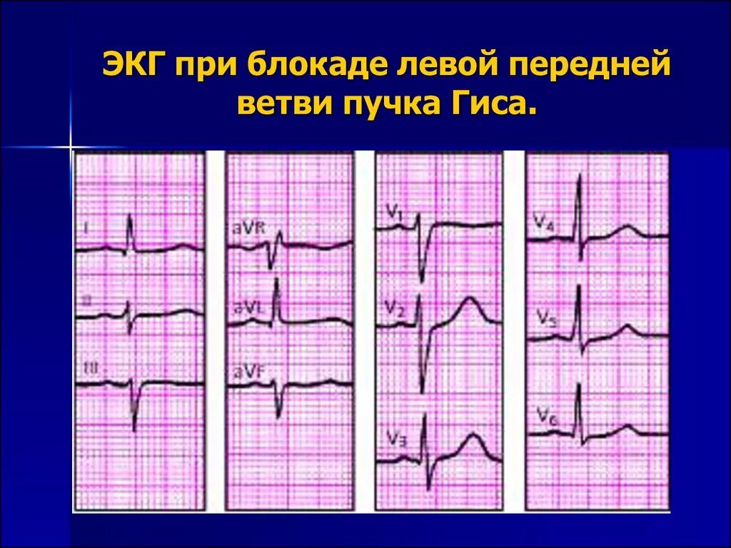 Блокада правого желудочка. Блокады ветвей пучка Гиса на ЭКГ. Блокада Гиса на ЭКГ. Внутрипредсердная блокада на ЭКГ. Блокада левой ножки пучка Гиса на ЭКГ.