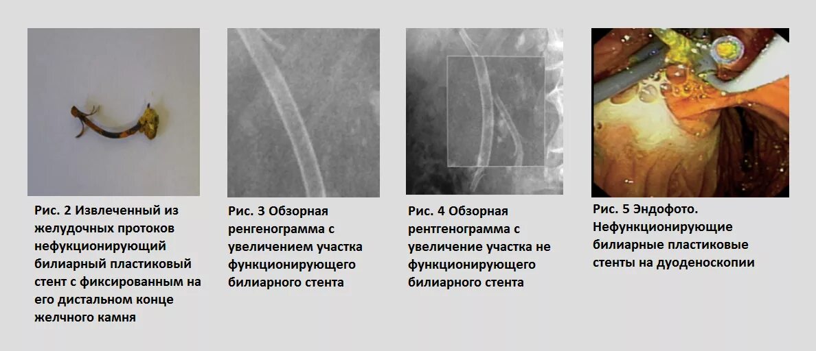 Эндоскопическое стентирование желчных протоков. Эндоскопическое стентирование холедоха. Стентирование холедоха желчного протока. Баллонной дилатации стентирование желчных протоков. Стент желчного протока