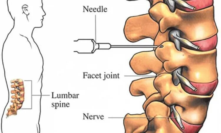 Фасеточная блокада. Фасеточные суставы шейного отдела позвоночника. Блокада фасеточных суставов поясничного отдела. Фасеточные суставы поясничного отдела. Фасетные суставы позвоночника.