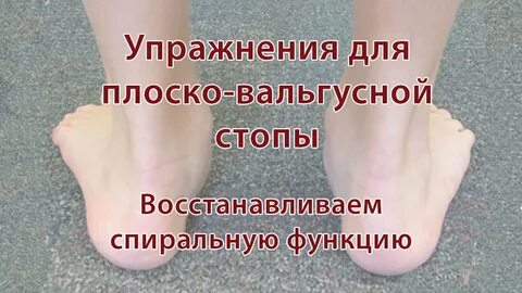 Мкб плоско вальгусная стопа у детей
