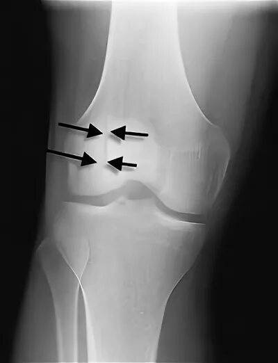 Надколенник коленного сустава перелом. S82. 0 Перелом надколенника. Подвывих надколенника рентген. Рентген колена перелом надколенника.