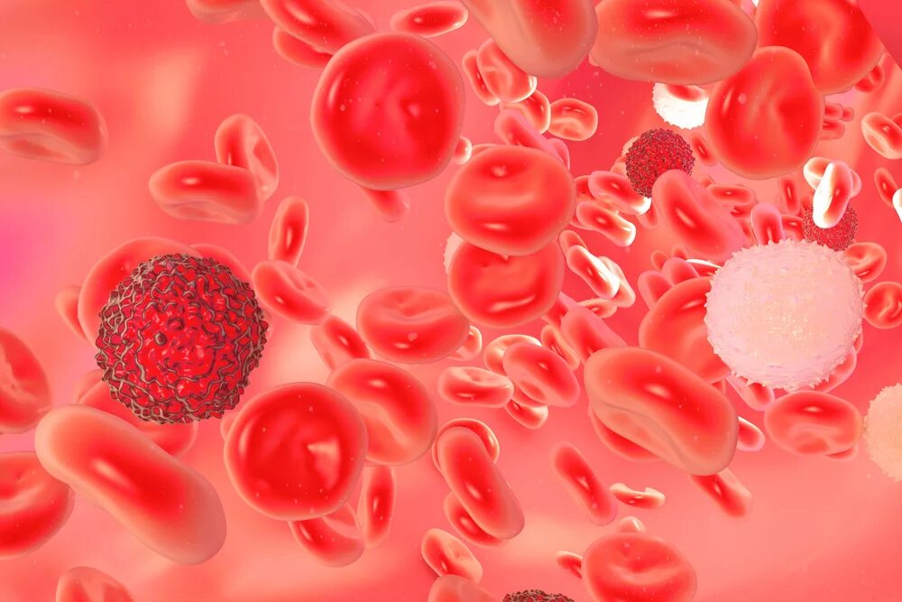 Лейкоз клетки крови. Острый лейкоз кровяные клетки. Злокачественные заболевания крови. Опухоль клеток крови