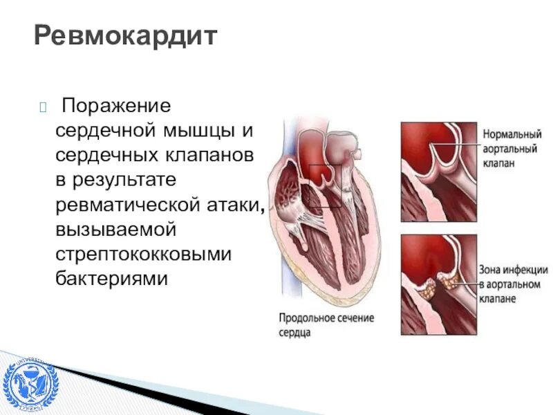 Основной признак ревмокардита. Кардиальная форма (ревмокардит).. Эндокардит миокардит перикардит. Симптомы ревматизм кардит. Пороки сердца при ревматической лихорадке.