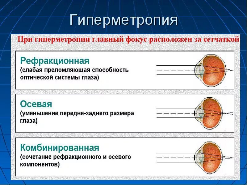 Миопия миопия гиперметропия. Глазные болезни гиперметропия. Клинические проявления гиперметропии. Гиперметропия клинические проявления и коррекция. Слабая миопия глаза что