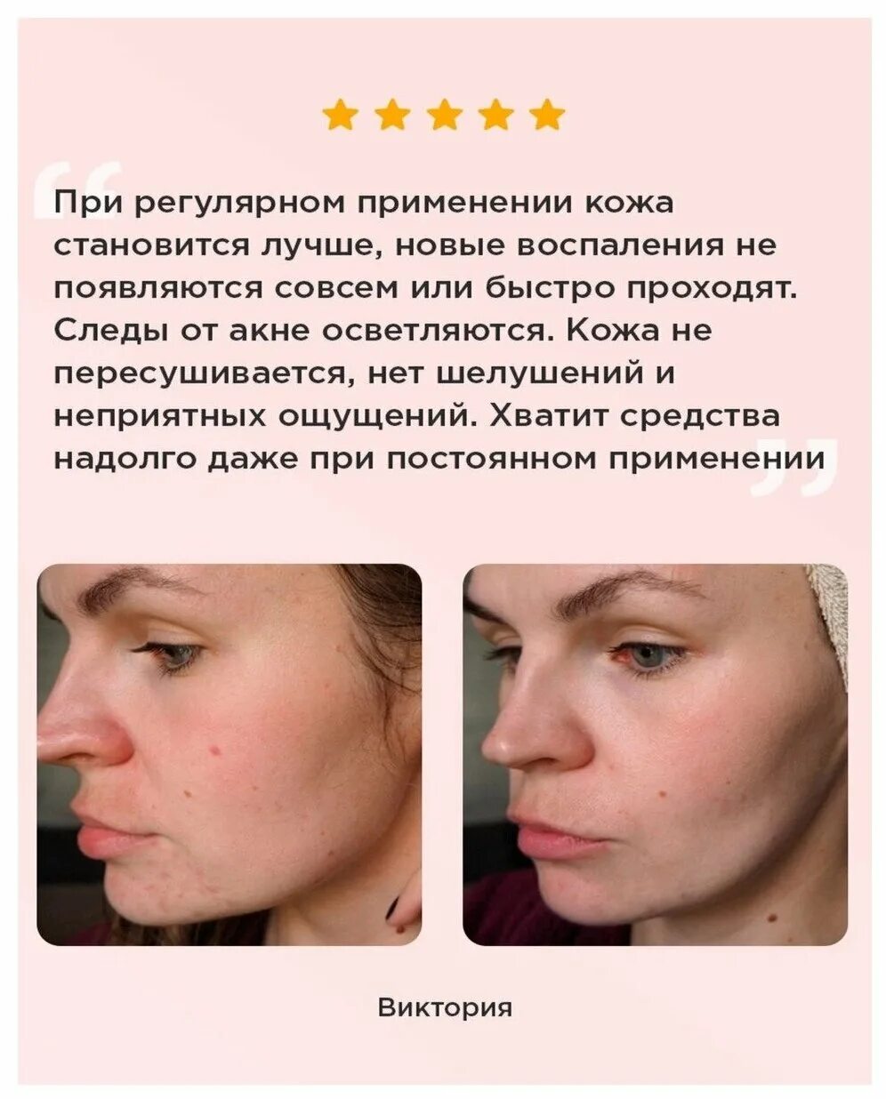 домашняя кислота для лица отзывы. домашняя кислота для лица отзывы. кислотный пилинг до и после. пилинг для лица с ана кислотами органик зон. домашняя кислота для лица отзывы.