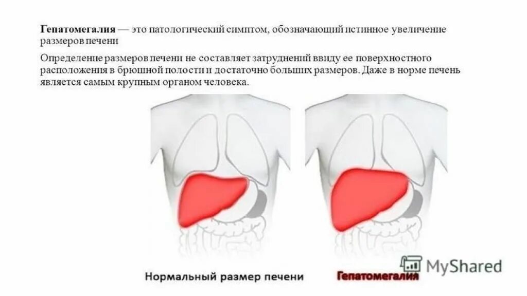 Гепатоза гепатомегалии. Гепатомегалия. Увеличение размеров печени. Степени гепатомегалии. Незначительная гепатомегалия.