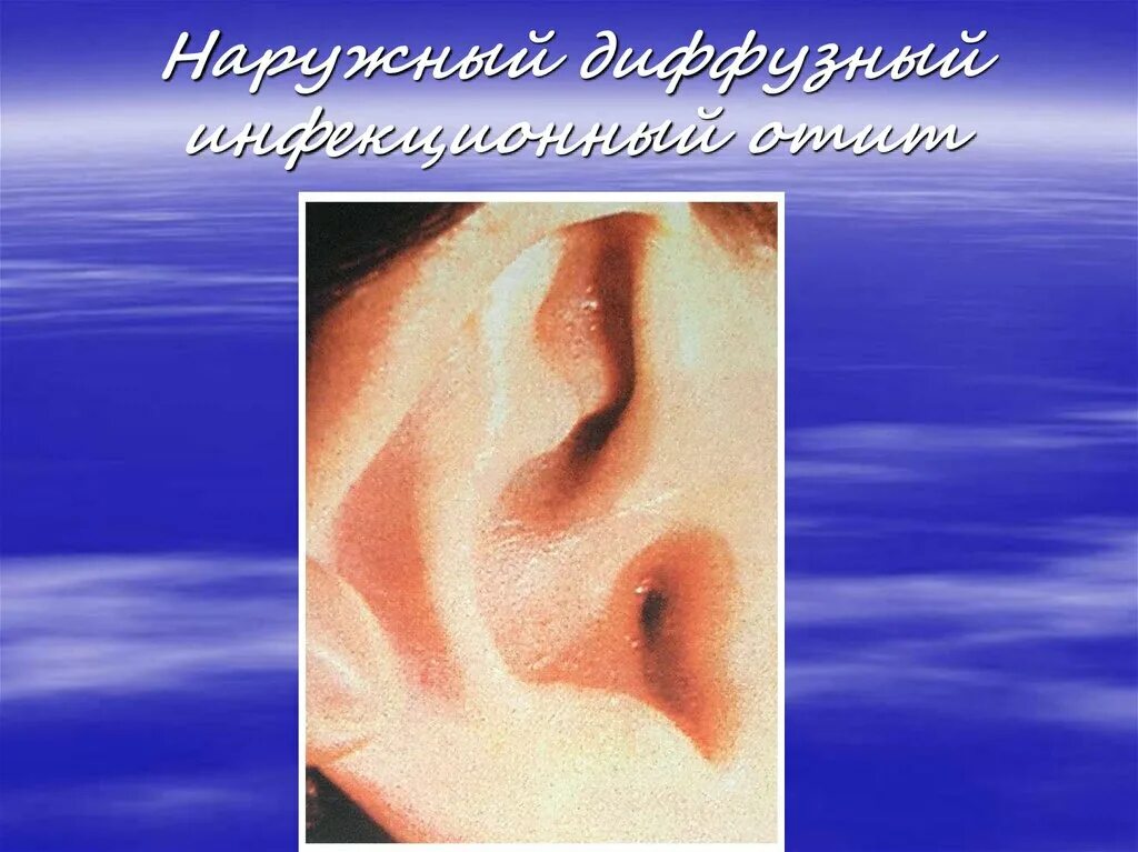 Диффузный гнойный. Наружный диффузный инфекционный отит. Диффузный наружный отит уха. Острый отит наружного слухового прохода.