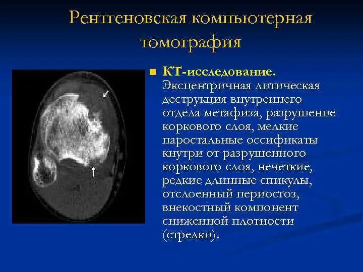 Очаг деструкции костной ткани рентген. Аневризмальная костная киста бедренной кости кт. Литическая деструкция что это. Литическая деструкция что это. Признаки деструкции кости на рентгене.