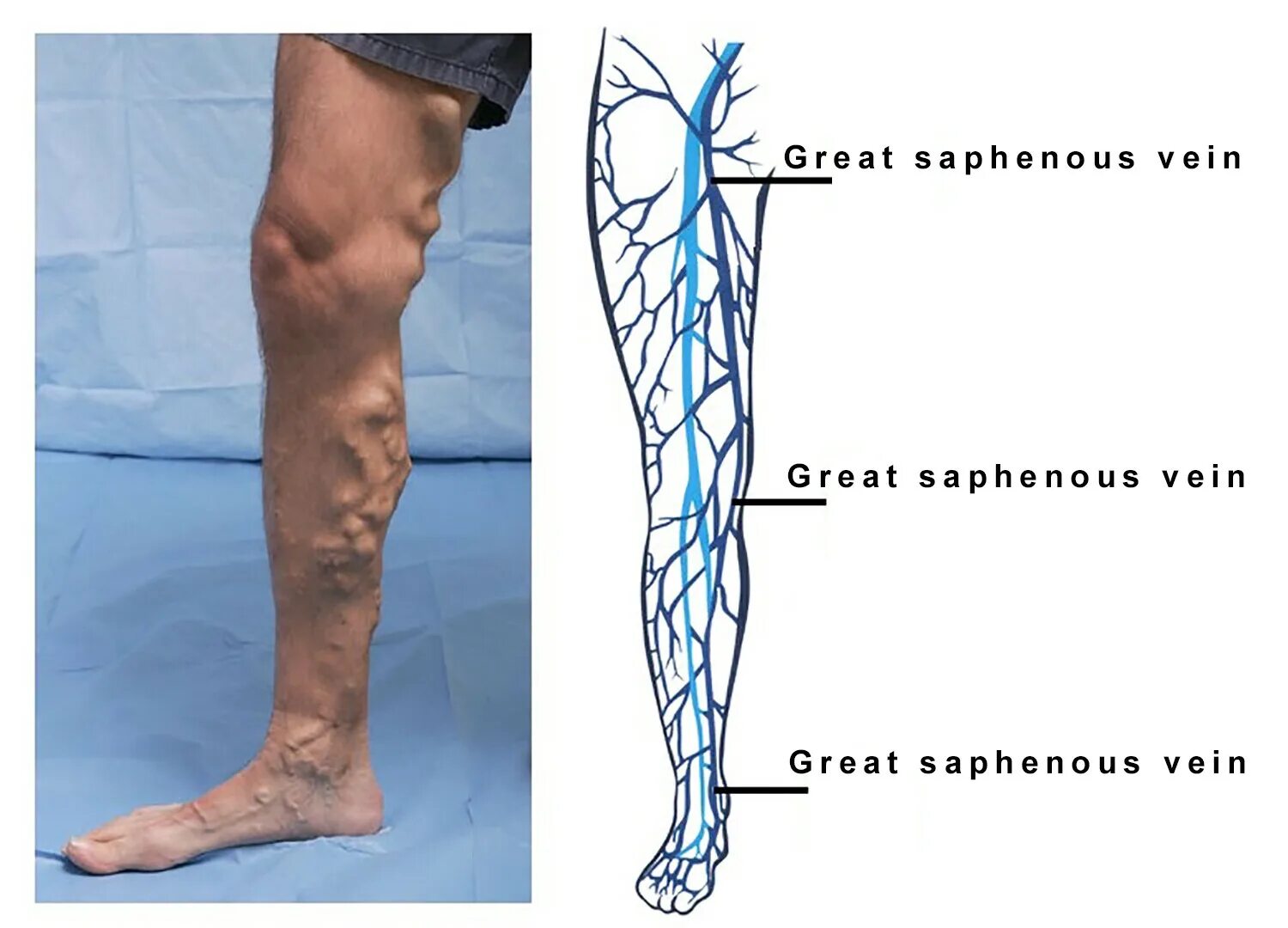 Тромбоз бедренных вен. Суральные вены тромбоз. Суральные вены нижних конечностей что это такое. Суральные вены голени анатомия.