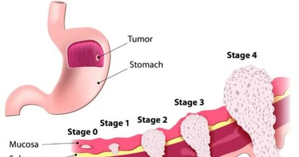 Рак желудка 4 сколько живут. Интрамуральные опухоли желудка. Неоплазия слизистой желудка. Раковая опухоль желудка. Доброкачественные опухоли желудка.