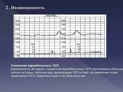 Вариабельность ритма снижена