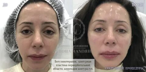 Глаз мезотерапия отек