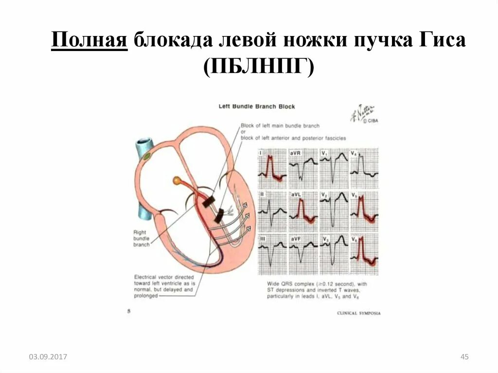 Полная блокада пучка ножки гиса лечение. Блокада левая ножка пучка Гиса. Блокада пучка Гиса 1576. Блокада левой ветви пучка Гиса. ФП И блокада левой ножки пучка Гиса.