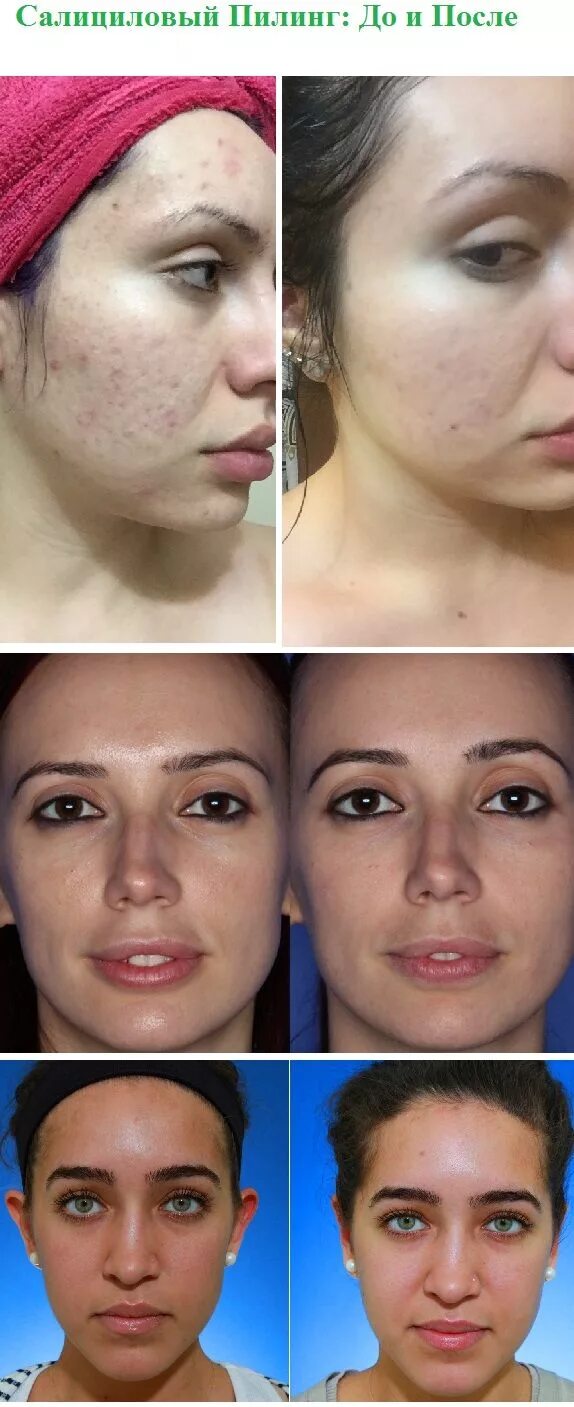 Салициловый пилинг цена skinlift ru. Салициловый пилинг до и после. Пилинг для лица. Лицо после салицилового пилинга.