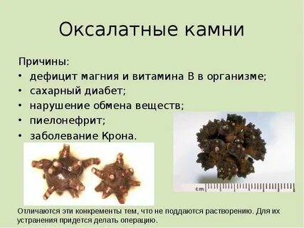 Оксалатные камни в почках причины