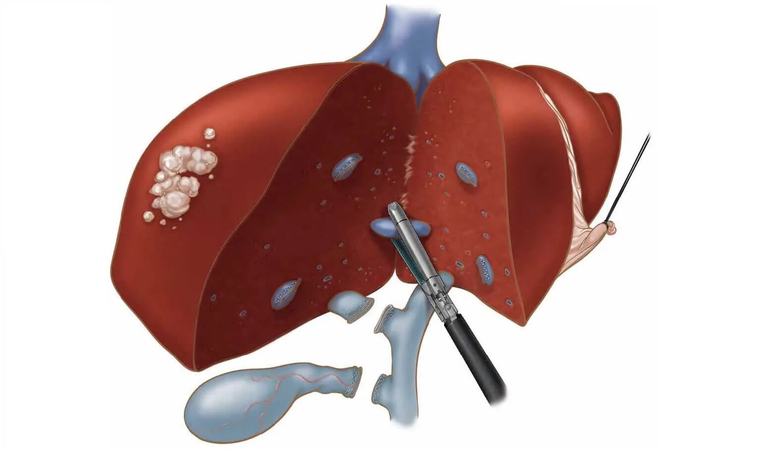 Лапароскопическая резекция печени. Операция печени резекций операции. Гемангиома печени хирургия. Удаление опухолей печени