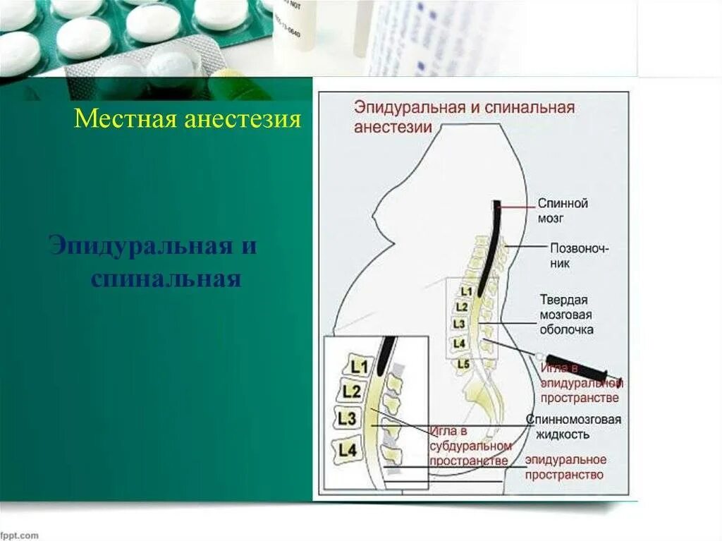 Эпидуральная спинная