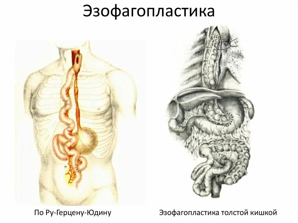 Искусственный пищевод. Эзофагопластика пищевода толстой кишкой. Тонкокишечная эзофагопластика по методу ру Герцена Юдина. Пластика пищевода толстой кишкой. Операция ру Герцена Юдина.