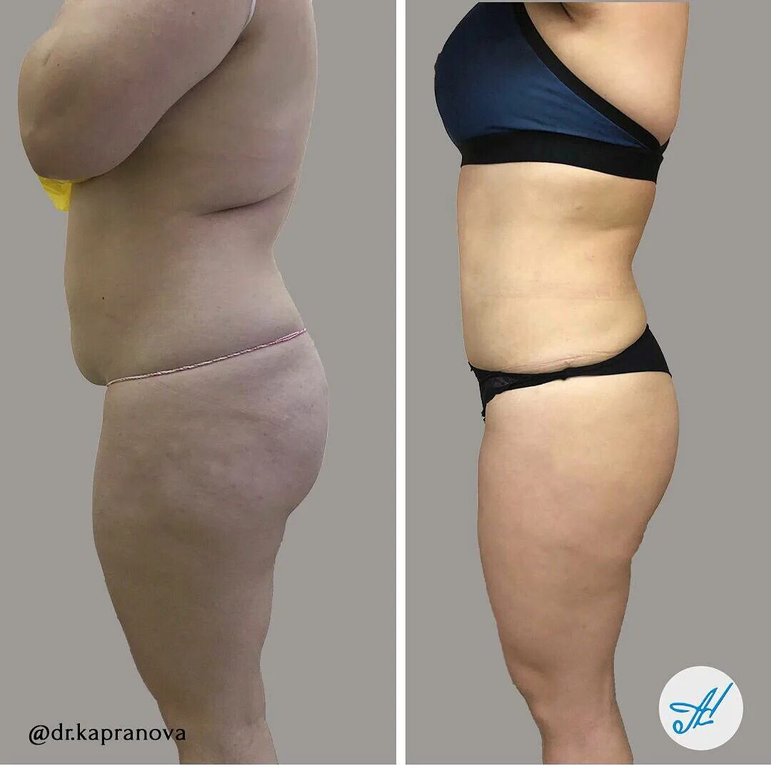 Липосакция живота у мужчин. Липосакция удаления. Липосакция удаления. Липосакция удаления. Миниабдоминопластика (пластика живота).