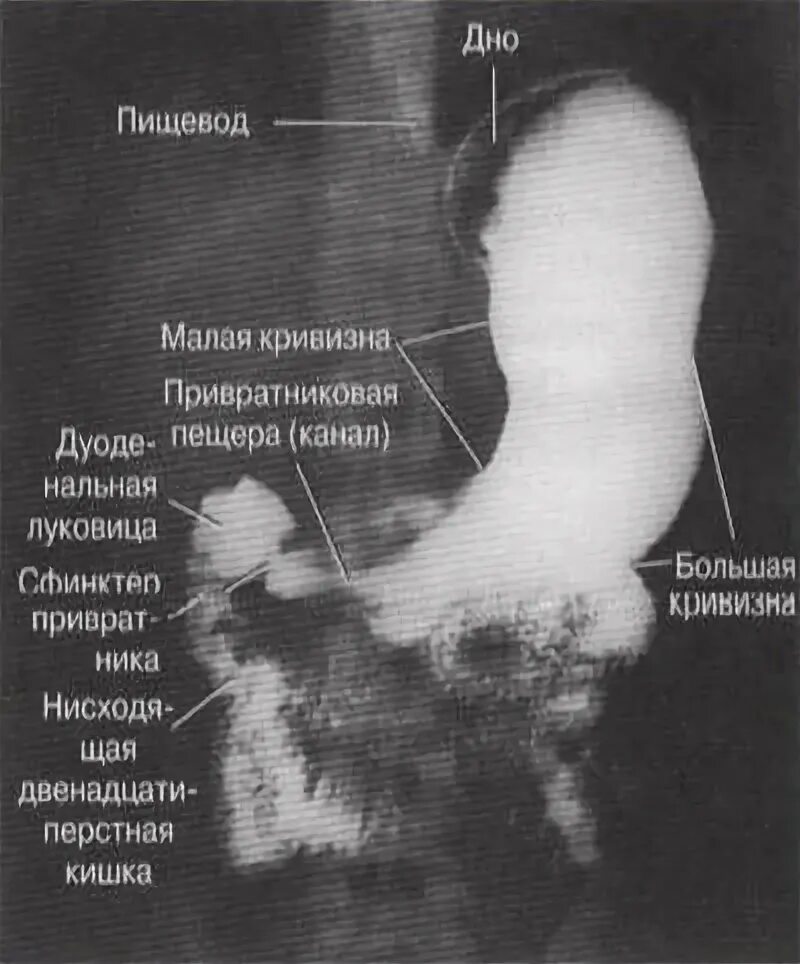Контрастная рентгенография желудка. Стеноз кардиального отдела желудка рентген. Рентген исследование желудка с барием. Рентген желудка что это. Рентген брюшной полости с контрастом.