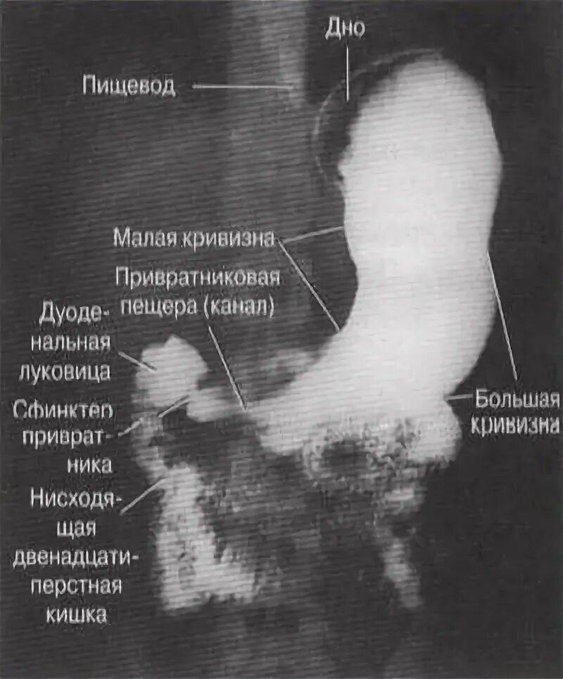 Рентгеноанатомия желудка. Рентгенография пищевода желудка и ДПК. Рентгеноскопия пищевода и желудка ДПК. Стеноз двенадцатиперстной кишки рентген.