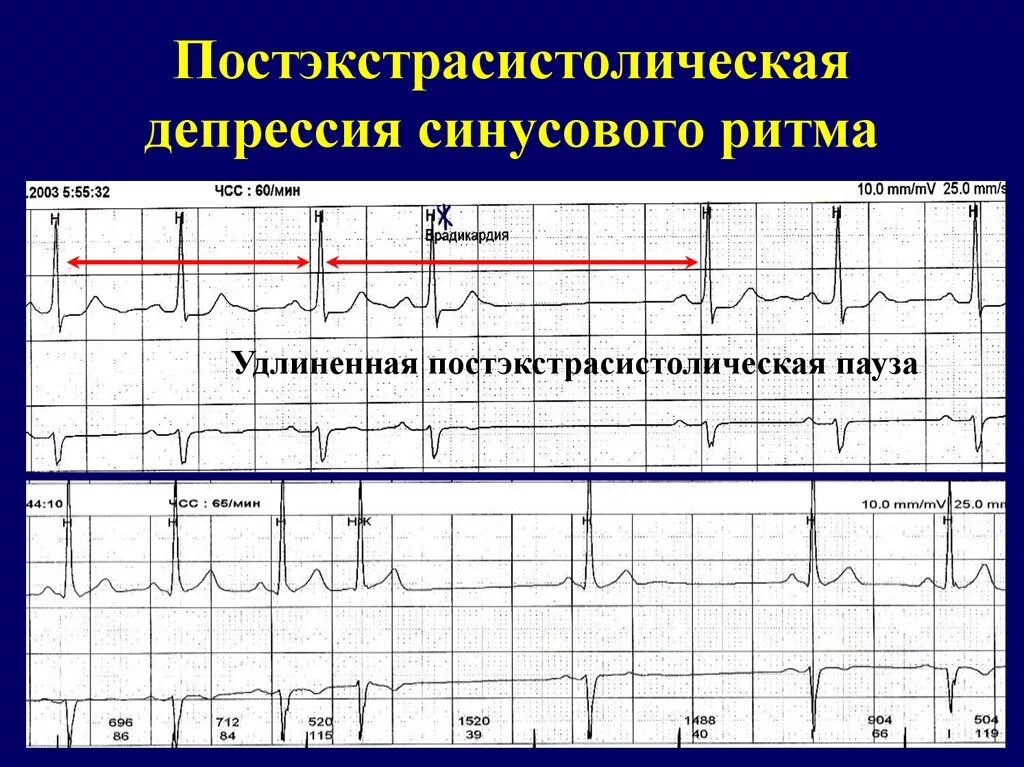 Сколько экстрасистол норма