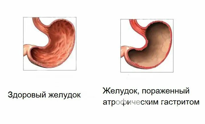 Ленивый желудок симптомы. Хронический атрофический гастрит ФГДС. Атрофический гастрит препарат. Атрофический гастрит слизистой оболочки желудка. Атрофический гастрит на ФГДС.