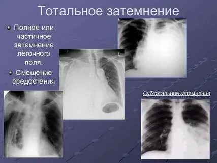 Затемнение рентгенограмма
