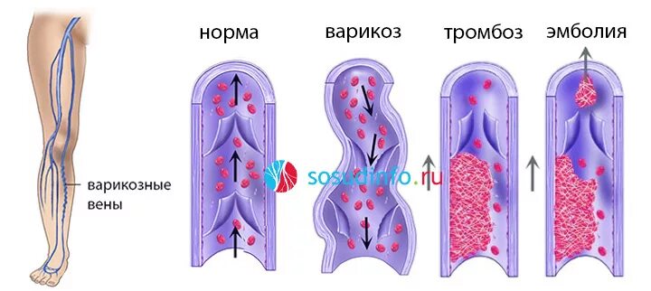 Варикозное расширение вен. Профилактика тромбозов и тромбоэмболий. Стадии развития варикоза. Стадии развития варикозного расширения вен. Степени тромбоза