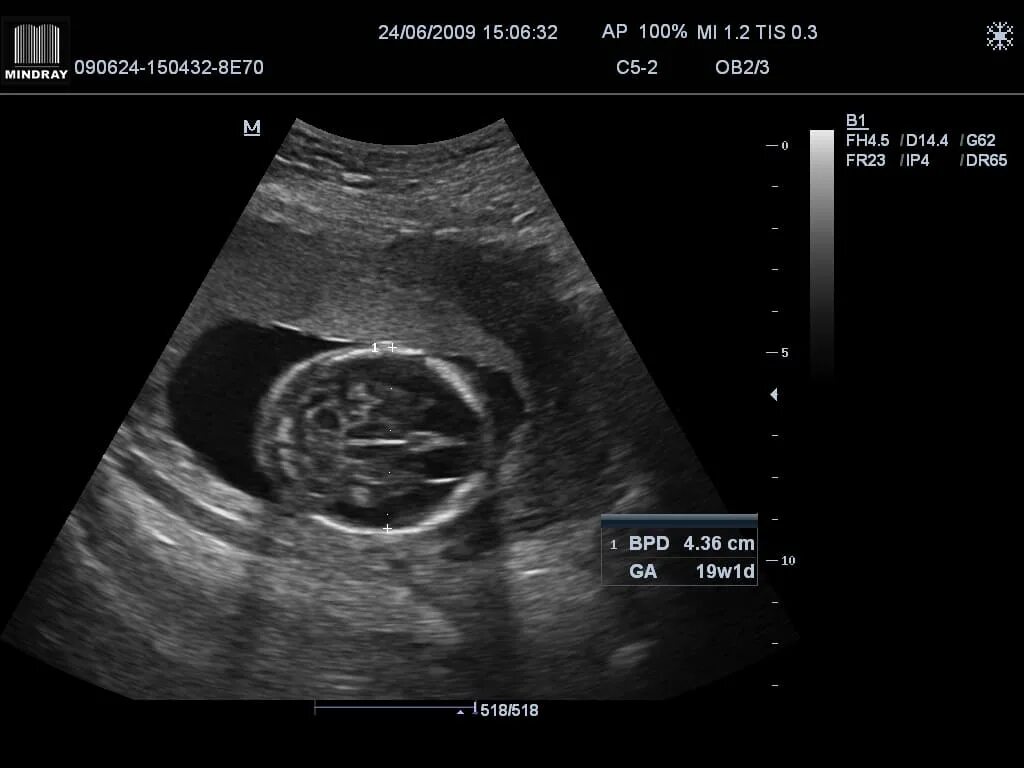 Снимок УЗИ на 19 неделе беременности. Малыш на 19 неделе беременности УЗИ. УЗИ ребенка на 19 неделе беременности на УЗИ. 19 Недель беременности фото плода на УЗИ. 19 неделя 2023