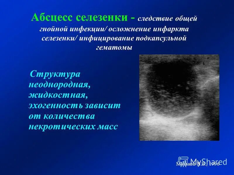 Очаговое образование селезенки. Патология селезенки на УЗИ. Хирургические заболевания селезенки. Абцесса селезенки.