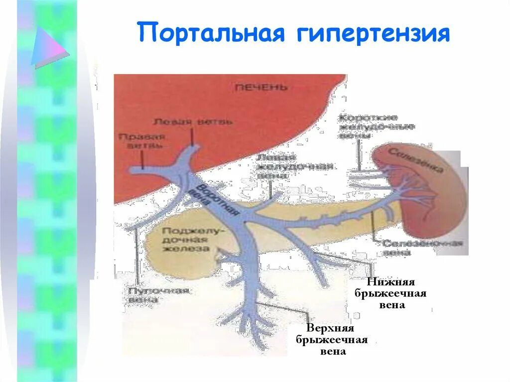 Печень расширены вены. Подпеченочная портальная гипертензия. Портальная гипертензия селезеночная Вена. Воротная Вена при циррозе печени.