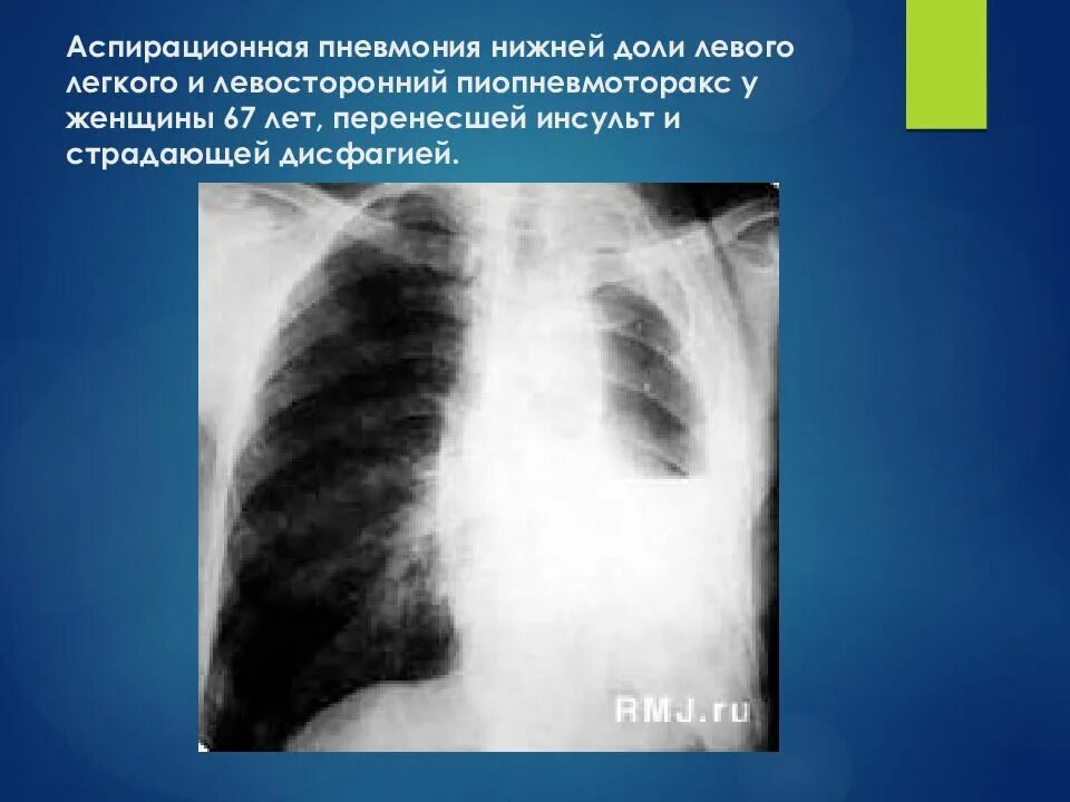 Боли в нижней доле легких. Аспирационная пневмония. Пневмония в нижней доле левого легкого. Аспирационная пневмония рентген.