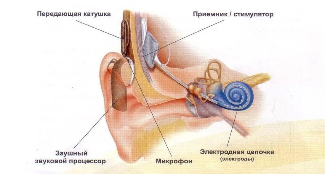 Кохлеарный имплант внутренняя часть. Кохлеарная имплантация строение уха. Кохлеарный имплант слух. Кохлеарный имплант строение. Операция на ухо на слух