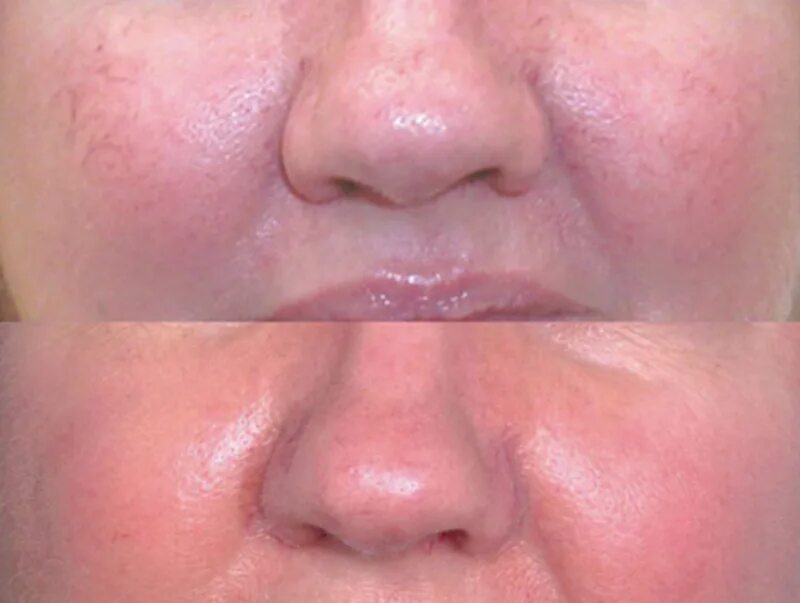 Как удалить звездочки на лице. Сосудистые звездочки розацеа. Розацеа фотокоагуляция. Как удалить звездочки на лице. Купероз и сосудистые звездочки.