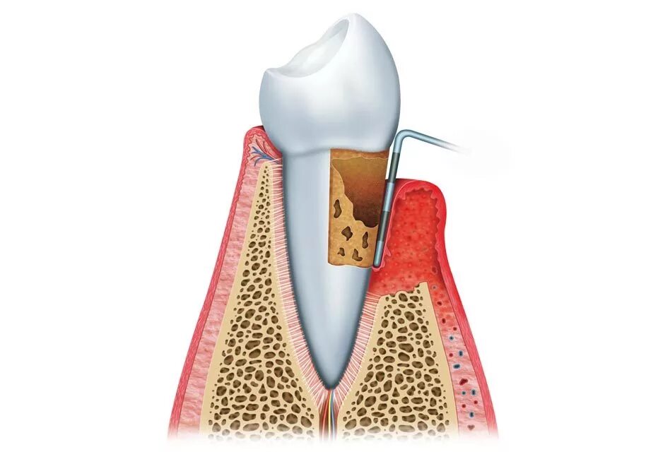 Индекс десна. Кюретаж пародонтального кармана. Периодонтит десневой карман. Рефрактерный пародонтит.